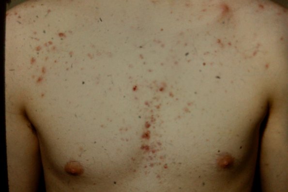 Acne Conglobata (5)