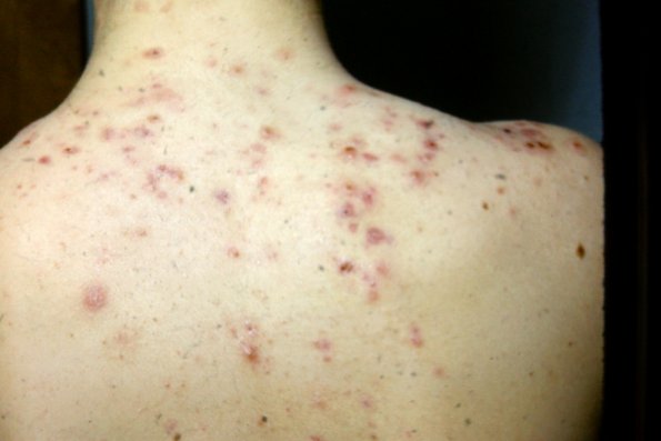 Acne Vulgaris (2)