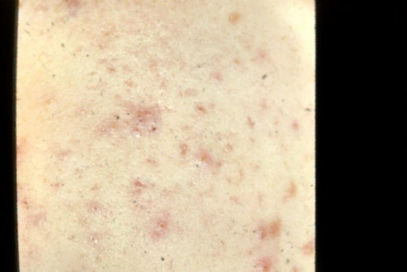 Acne Vulgaris (3)