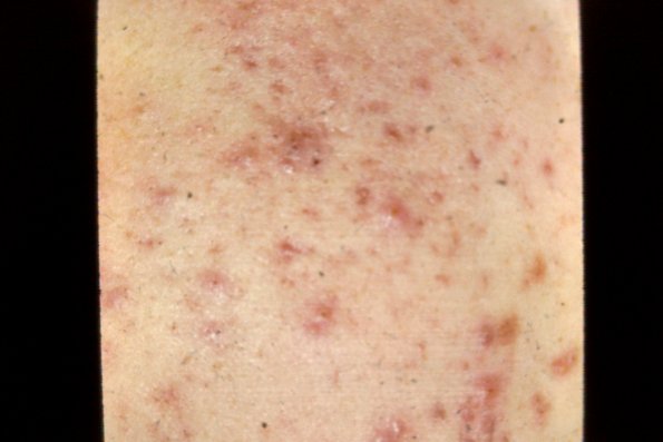 Acne Vulgaris