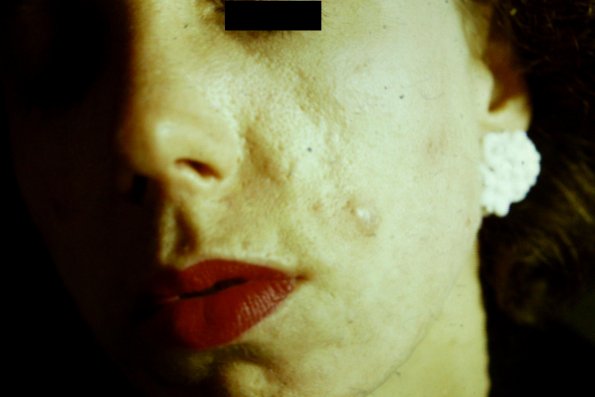 Cystic Acne (2)