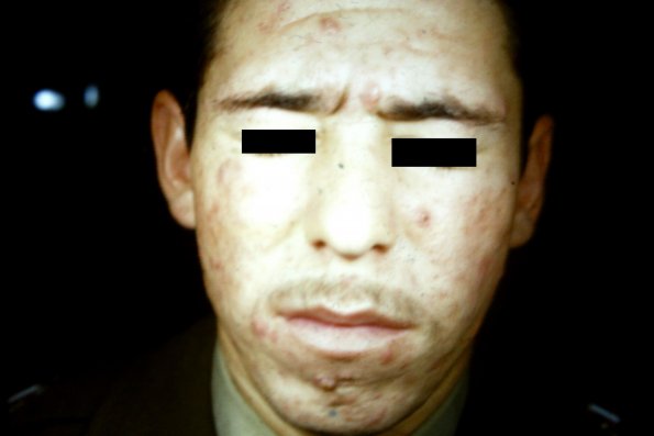 Cystic Acne