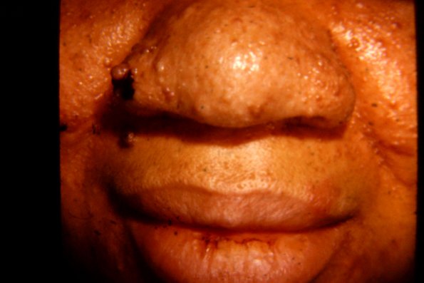 Adenoma Sebaceum (6)