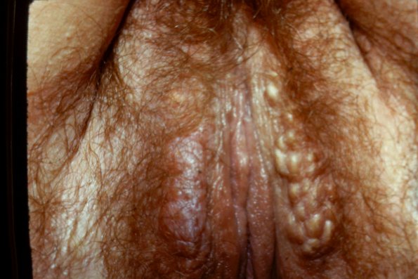 Sebaceous Adenoma