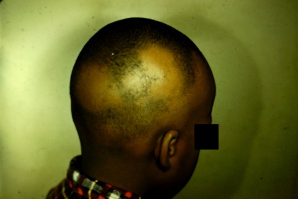 Alopecia Areata (2)