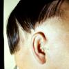 Alopecia Areata (3)