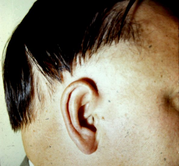 Alopecia Areata (6)