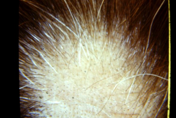 Alopecia Areata (8)