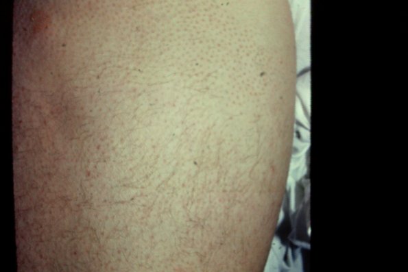 Alopecia Mucinosa (8)