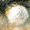 Alopecia Mucinosa