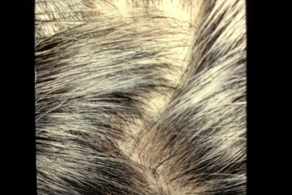 Estrogen Deficiency Alopecia