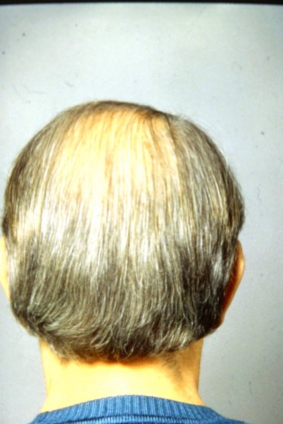Female pattern common baldness (2)