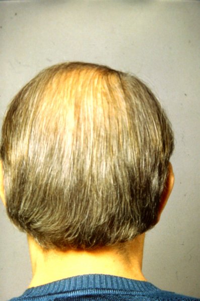Female pattern common baldness
