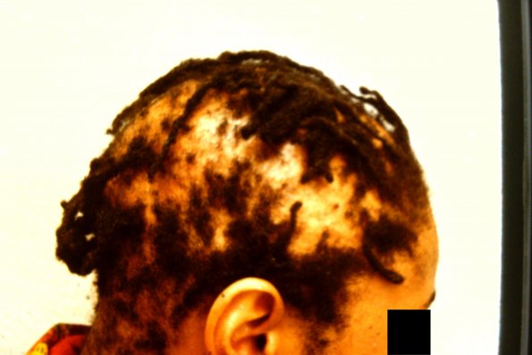 Scarring Alopecia (3)