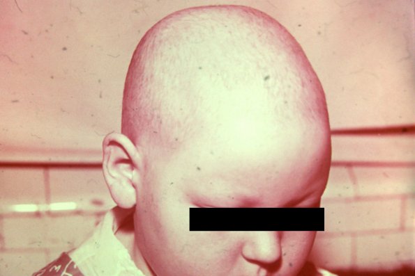 Alopecia Totalis (2)