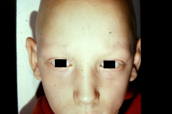 Alopecia Totalis (3)