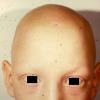 Alopecia Totalis (4)