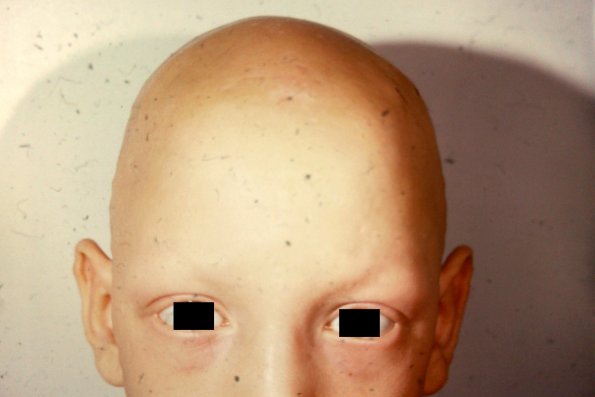 Alopecia Totalis (4)