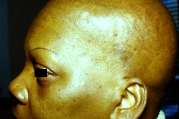Alopecia Totalis (5)