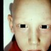 Alopecia Totalis - Alopecia Areata Universalis
