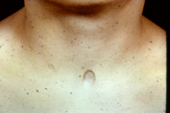 Anetoderma (4)