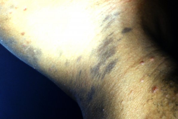 Ashy Dermatosis (2)