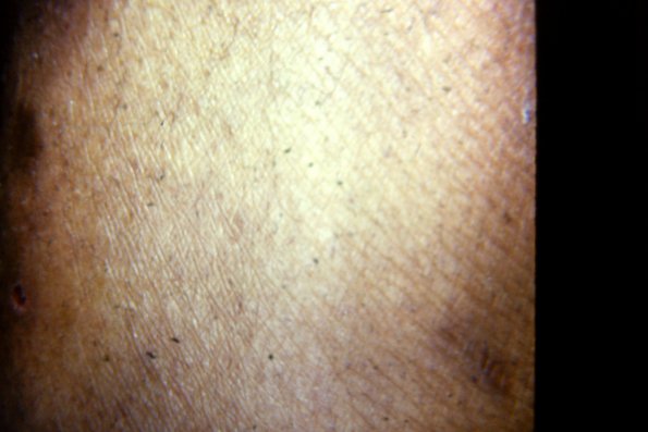 Asteatosis (6)