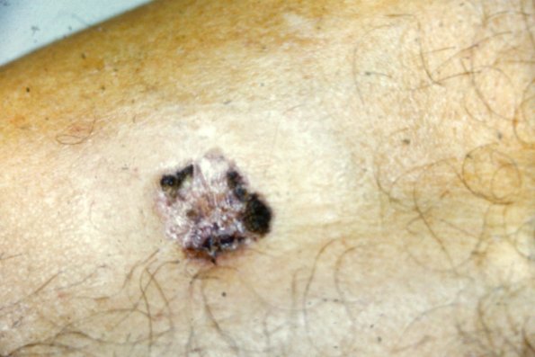 Bowen's Disease (9)