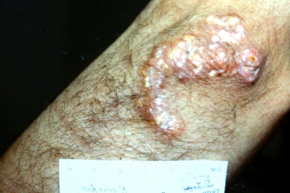 Calcinosis Cutis (3)