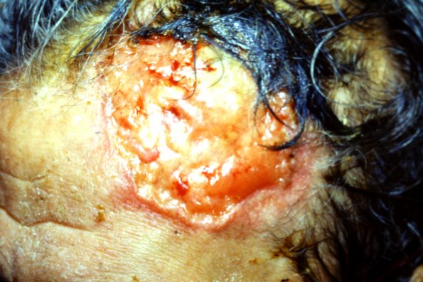 Basal Cell Carcinoma