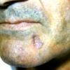 Basal Cell Epithelioma (6)