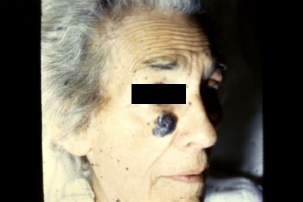 Malignant Melanoma (3)