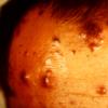 Malignant Melanoma (4)