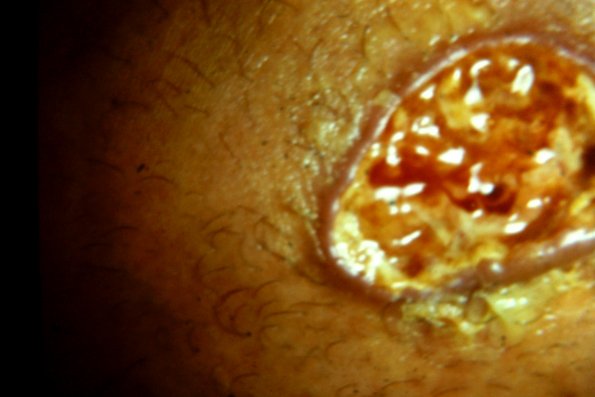 Malignant Melanoma (7)