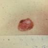 Melanoma (16)