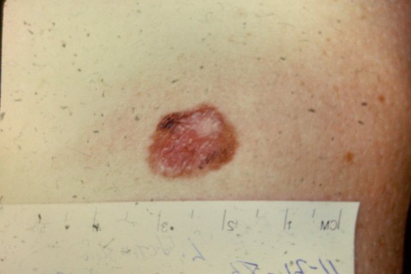 Melanoma (16)