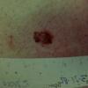 Melanoma (17)