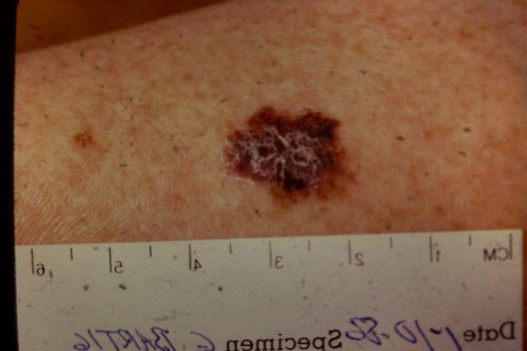 Melanoma (19)