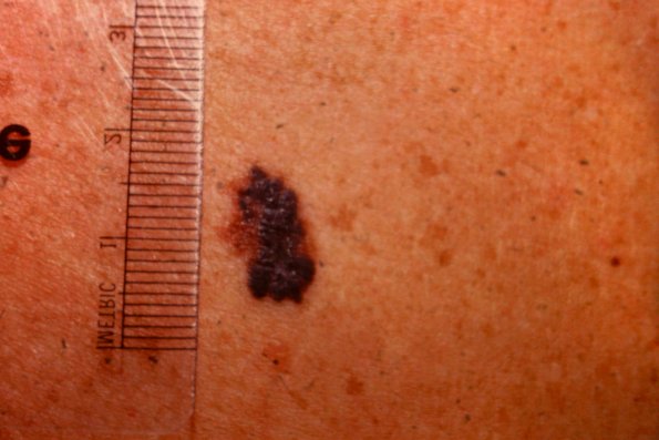 Melanoma (25)