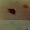 Melanoma (30)