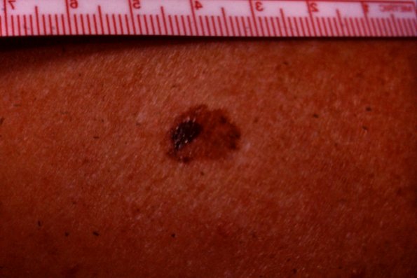 Melanoma (47)