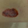 Melanoma (5)