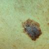 Melanoma (6)