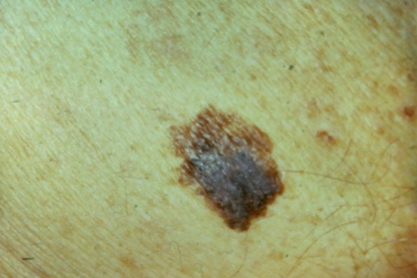 Melanoma (6)