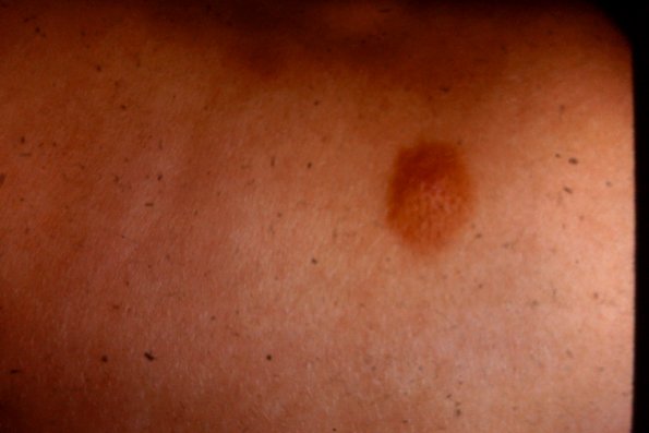 Melanoma (71)