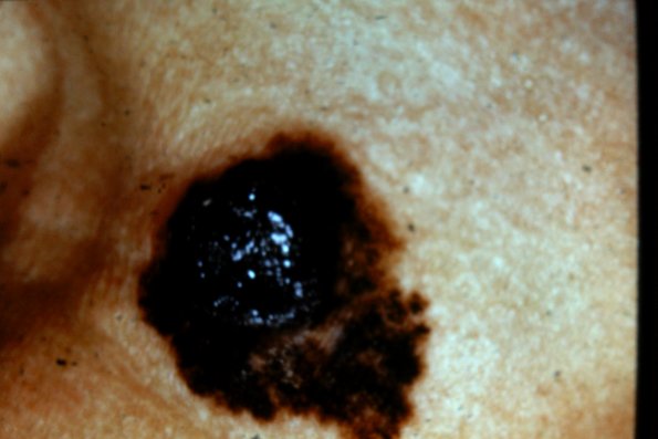 Melanoma (77)