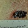 Melanoma (9)