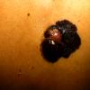 Melanoma Binodular