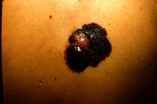 Melanoma Binodular