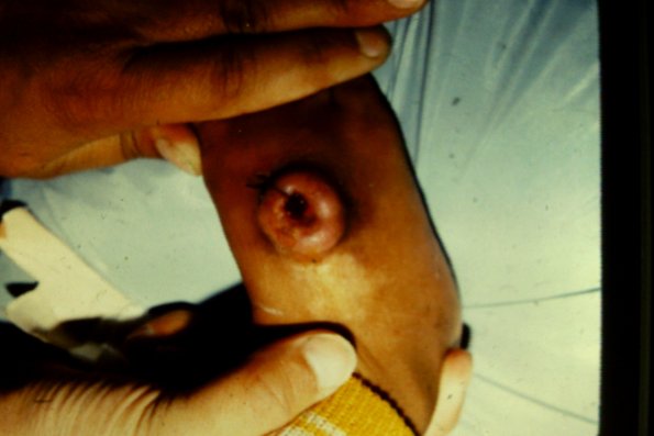 Melanomain Syecroid